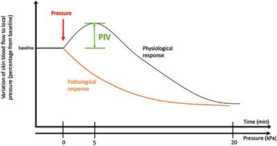 Alteration of Pressure-Induced Vasodilation in Aging and Diabetes, a Neuro-Vascular Damage